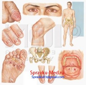 Заболевание такое как Сифилис Заболевание такое как Сифилис